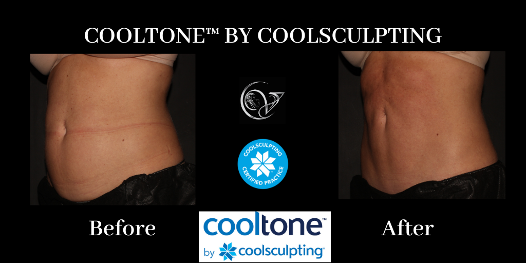 Cooltone By CoolSculpting Before And After Vitality Antiaging Center