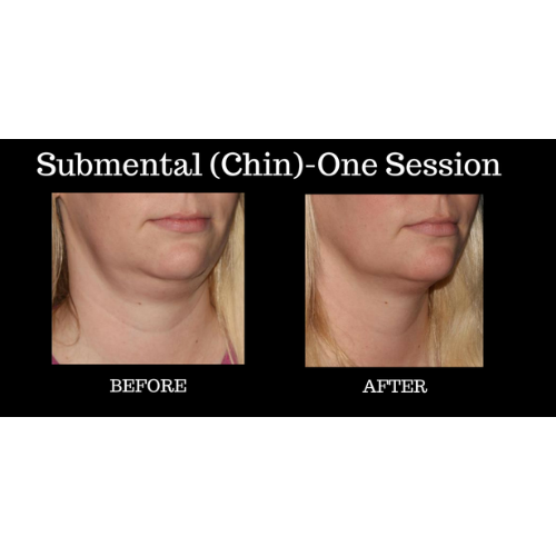 coolsculpting before and after chin